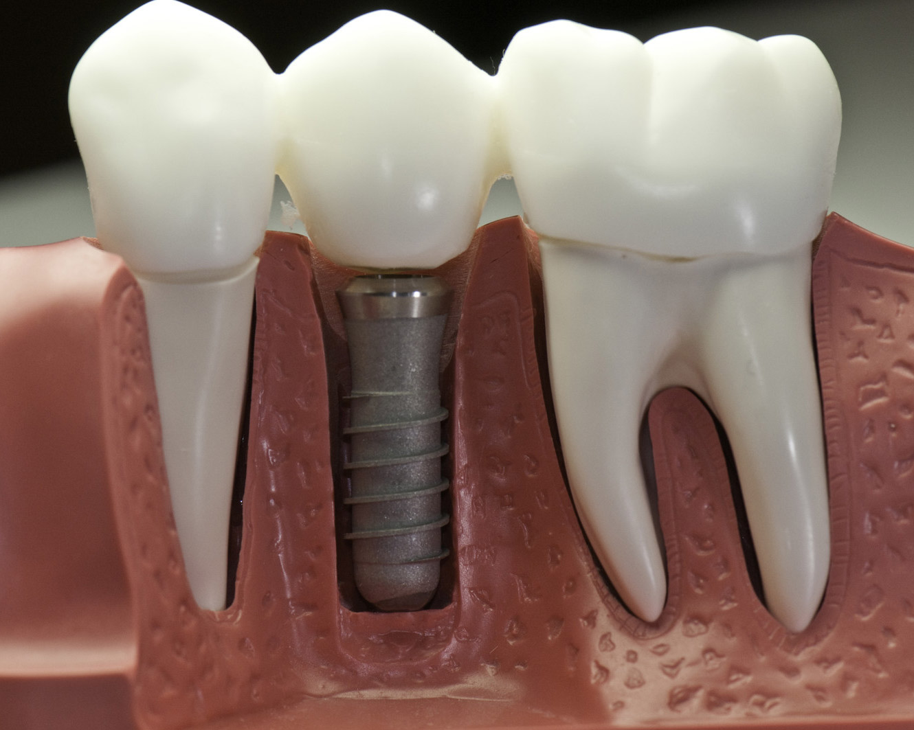 dental implants in dearborn