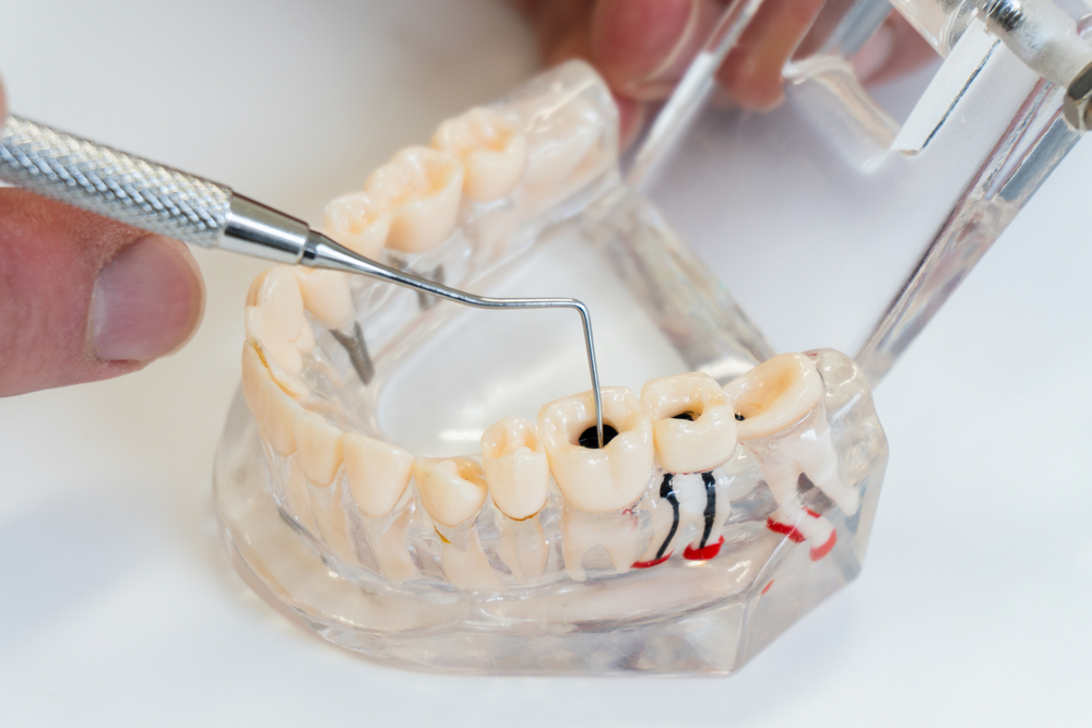is root canal therapy really as painful as people say